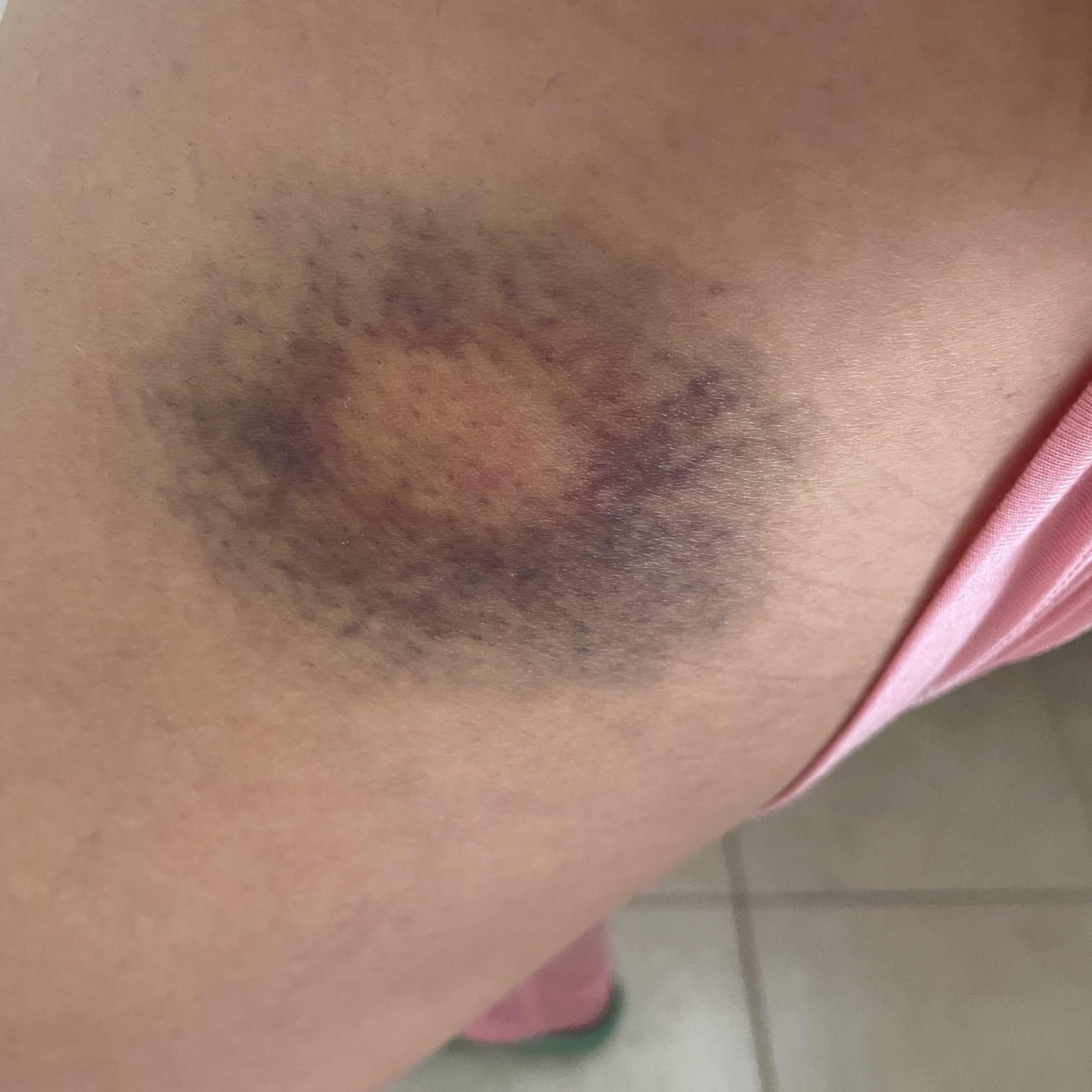Close up photo of a bruised leg