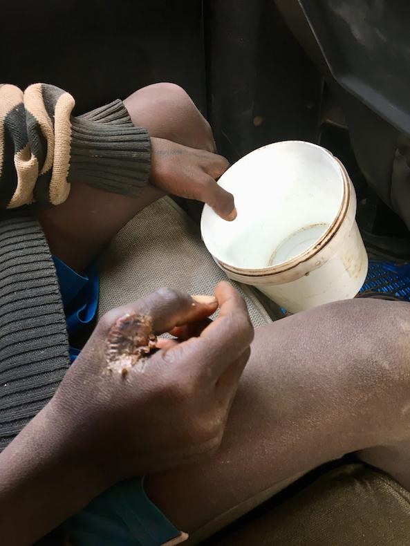 A talibé child reveals his untreated hand injury, holding a begging bowl in his other hand. The child attended the same Quranic school in Louga as the victim of the January 13 motorcycle accident.