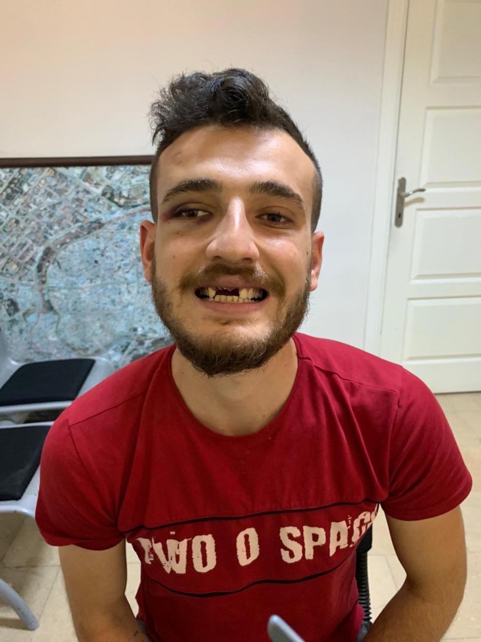 Halit Eray Tosun alleges he was beaten in the police station by police officers who broke three of his teeth.© 2020 Private