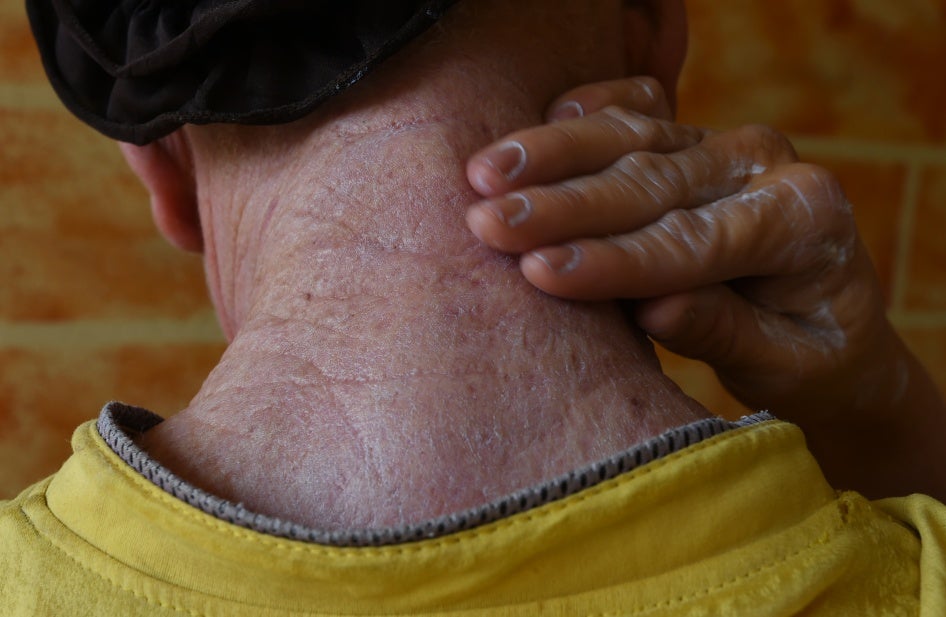 A man with albinism covers himself in sunscreen prepared by members of an NGO on August 18, 2016, in Abidjan, Côte d’Ivoire. 